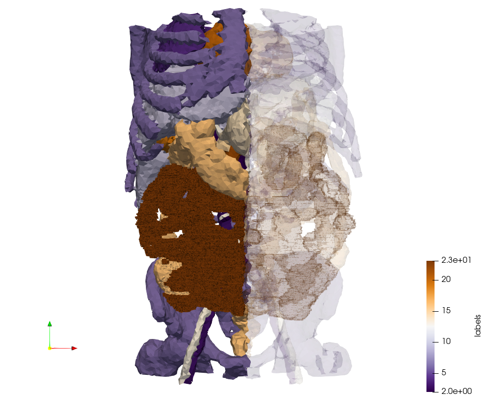 Ircad2-Removed-Tissues,d=5.png