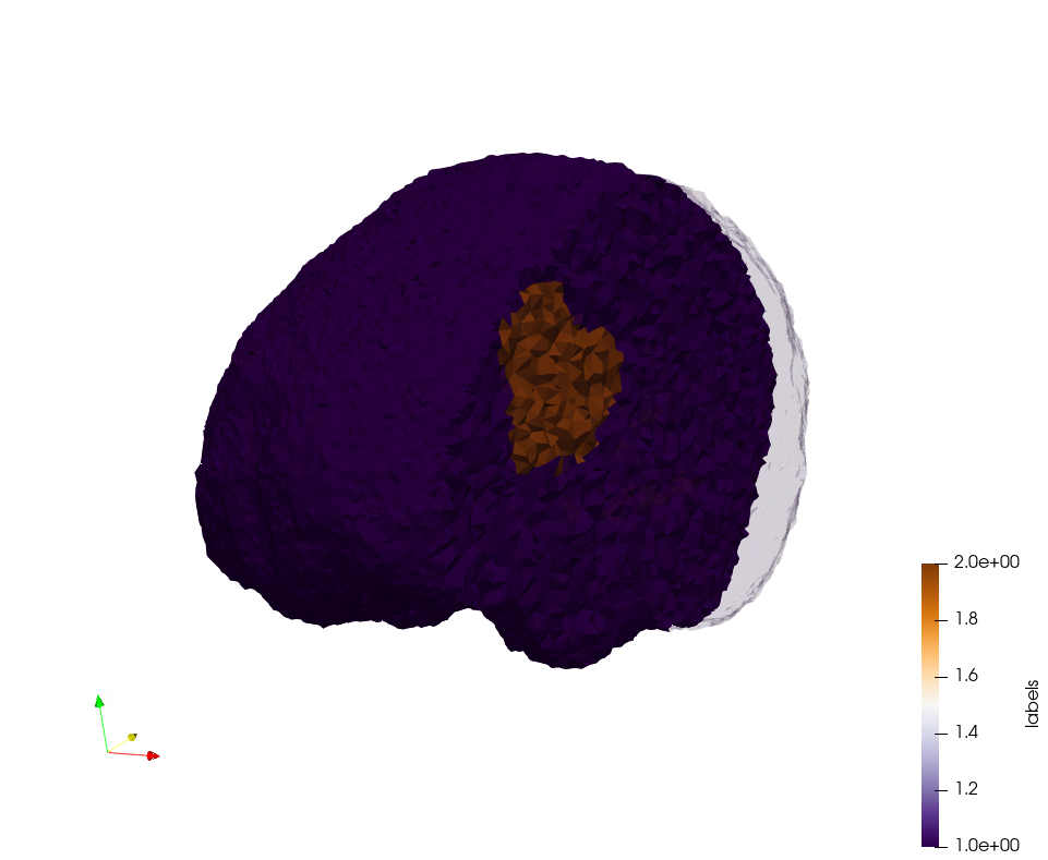 Brain-With-Tumor-Case17,d=1.5.png