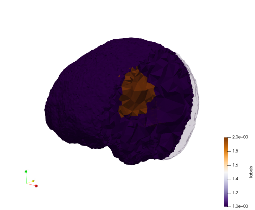 Brain-With-Tumor-Case17,d=1.5,grading.png