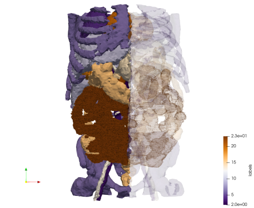 Ircad2-Removed-Tissues,d=5.png