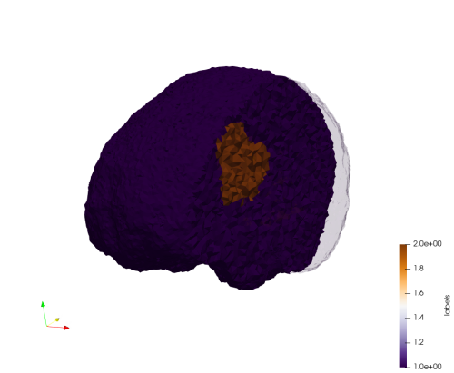 Brain-With-Tumor-Case17,d=1.5.png